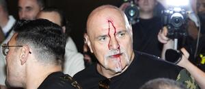 John Fury si ze šarvátky odnesl krvavé zranění John Fury si ze šarvátky odnesl krvavé zranění